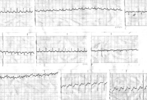manual_cardiologia_pautas/taquicardia_paroxistica_intranodal_5 manual_cardiologia_pautas/taquicardia_paroxistica_intranodal_5