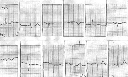 manual_cardiologia_pautas/taquicardia_paroxistica_intranodal_6 manual_cardiologia_pautas/taquicardia_paroxistica_intranodal_6
