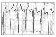 manual_cardiologia_pautas/taquicardia_paroxistica_supraventricular_ortodromica