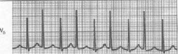 manual_cardiologia_pautas/taquicardia_paroxistica_via_accesoria_oculta_1