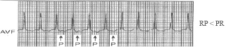 manual_cardiologia_pautas/taquicardia_paroxistica_via_accesoria_oculta_2