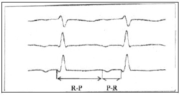 manual_cardiologia_pautas/taquicardia_supraventricular