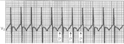 manual_cardiologia_pautas/taquicardia_supraventricular_2