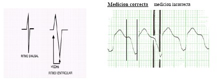 manual_cardiologia_pautas/taquicardia_ventricular_1