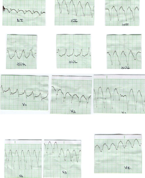 manual_cardiologia_pautas/taquicardia_ventricular_2