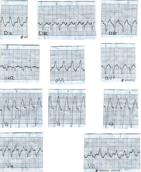 manual_cardiologia_pautas/taquicardia_ventricular_3