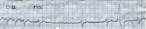 manual_cardiologia_pautas/taquicardia_ventricular_4
