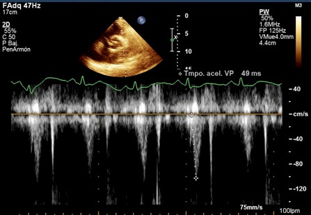 miocardiopatia_dilatada_radiacion/miocardiopatia_dilatada_ecografia