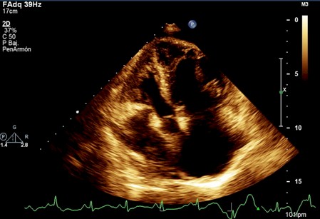 miocardiopatia_dilatada_radiacion/miocardiopatia_dilatada_ecografia_2