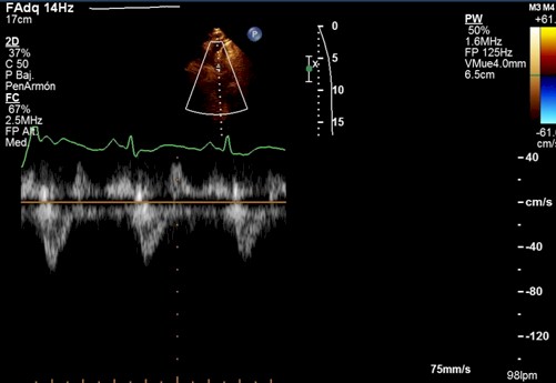 miocardiopatia_dilatada_radiacion/miocardiopatia_dilatada_ecografia_3