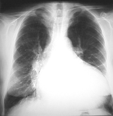 miocardiopatia_dilatada_radiacion/miocardiopatia_dilatada_radiografia