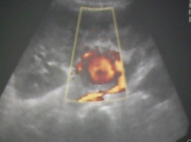 nefropatia_BK_VBK/ecografia_doppler_renal_arteria_pseudoaneurisma nefropatia_BK_VBK/ecografia_doppler_renal_arteria_pseudoaneurisma