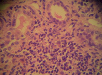nefropatia_BK_VBK/trasplante_renal_infiltrado_mononuclear_intersticial nefropatia_BK_VBK/trasplante_renal_infiltrado_mononuclear_intersticial