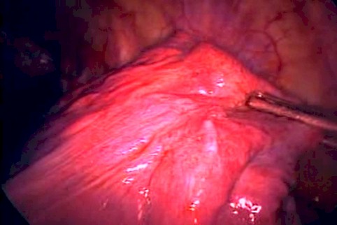 neumotorax_catamenial_videotoracoscopia_6