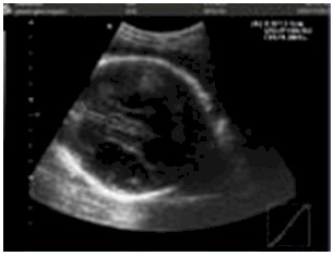 caso_clinico/porencefalia_ecografia_sonografia caso_clinico/porencefalia_ecografia_sonografia