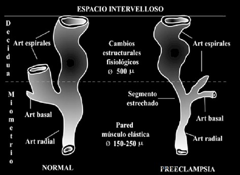preeclamsia/espacio_intervelloso_preeclampsia