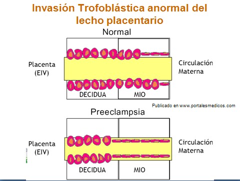 preeclamsia/invasion_trofoblastica_lecho_placentario_2