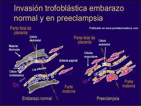 preeclamsia/invasion_trofoblastica_lecho_placentario_3