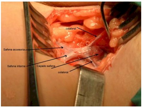 safenectomia_variz/safenectomia_tecnica_diseccion_cayado_safena_interna