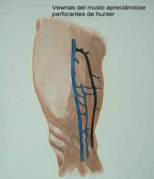 safenectomia_variz/varices_safena_interna_perforantes safenectomia_variz/varices_safena_interna_perforantes