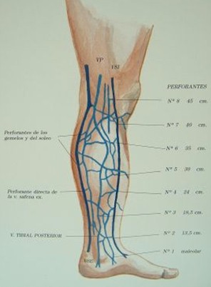 safenectomia_variz/varices_safena_interna_perforantes_2 safenectomia_variz/varices_safena_interna_perforantes_2