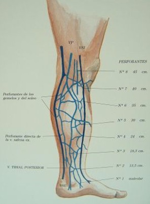 safenectomia_variz/varices_safena_interna_perforantes_2