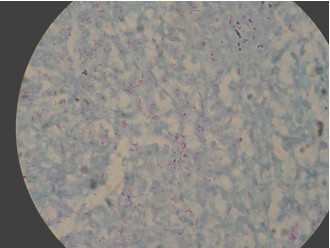 tuberculosis_extrapulmonar/anatomia_patologica_tuberculosis_laringea tuberculosis_extrapulmonar/anatomia_patologica_tuberculosis_laringea