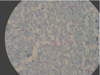 tuberculosis_extrapulmonar/anatomia_patologica_tuberculosis_laringea