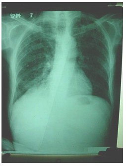 tuberculosis_extrapulmonar/radiografia_tuberculosis_laringea
