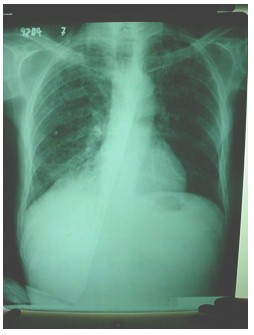 tuberculosis_extrapulmonar/radiografia_tuberculosis_laringea tuberculosis_extrapulmonar/radiografia_tuberculosis_laringea