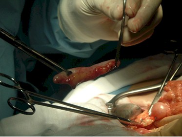 apendicitis_caso_clinico/apendice_extirpacion_extraccion