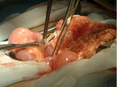 apendicitis_caso_clinico/apendicectomia_apendice_intestino