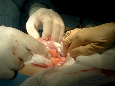 apendicitis_caso_clinico/apendicectomia_incision_pararrectal