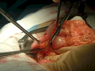 apendicitis_caso_clinico/apendicitis_imagen_apendice