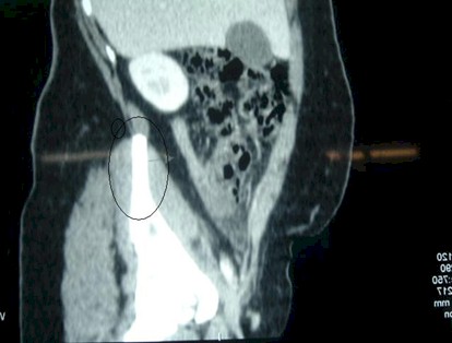 apendicitis_caso_clinico/apendicitis_retrocecal_TAC