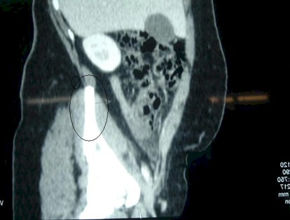 apendicitis_caso_clinico/apendicitis_retrocecal_TAC