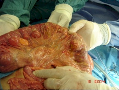 caso_clinico_peritonitis_diverticulosis/hallazgos_cirugia_diverticulosis_diverticulitis