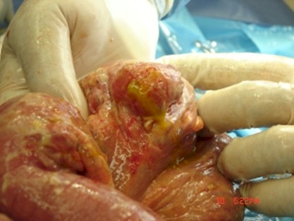 caso_clinico_peritonitis_diverticulosis/hallazgos_cirugia_peritonitis_purulenta_perforacion caso_clinico_peritonitis_diverticulosis/hallazgos_cirugia_peritonitis_purulenta_perforacion