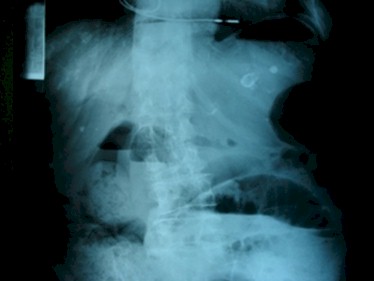 caso_clinico_peritonitis_diverticulosis/rx_radiografia_abdomen_perforacion_diverticulo