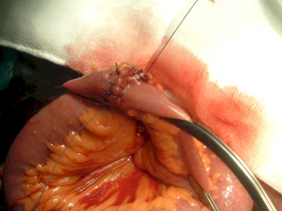 cirugia_hernia_crural_irreductible/anastomosis_intestinal_termino_terminal