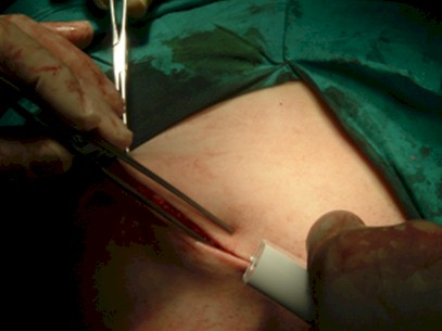 cirugia_hernia_crural_irreductible/cierre_piel_sutura_mecanica cirugia_hernia_crural_irreductible/cierre_piel_sutura_mecanica