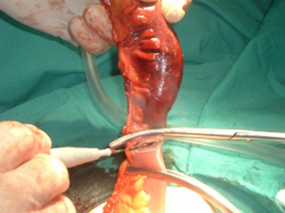 cirugia_hernia_crural_irreductible/extirpacion_asa_intestinal_herniada cirugia_hernia_crural_irreductible/extirpacion_asa_intestinal_herniada
