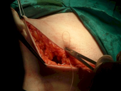 cirugia_hernia_crural_irreductible/herniorrafia_ligamento_Cooper_crural