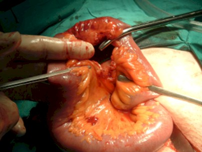 cirugia_hernia_crural_irreductible/reseccion_asa_intestinal_herniada