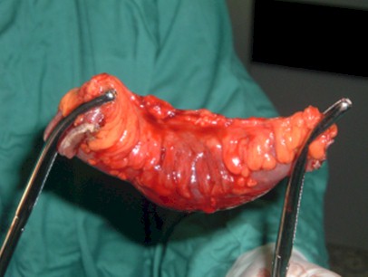 cirugia_hernia_crural_irreductible/segmento_intestinal_resecado_necrosis