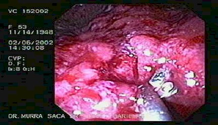 enfermedad_crohn_colitis_ulcerosa/biopsia_intestinal_displasia_colitis_ulcerativa