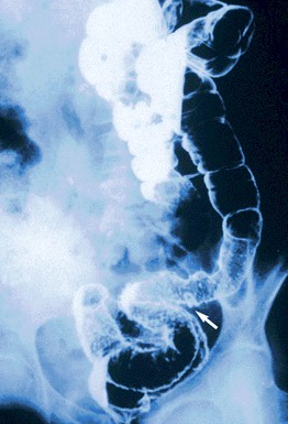 enfermedad_crohn_colitis_ulcerosa/colitis_ulcerosa_radiografia_abdominal_contraste