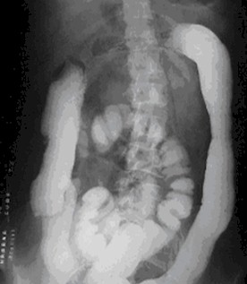 enfermedad_crohn_colitis_ulcerosa/colitis_ulcerosa_radiografia_tubo_rigido