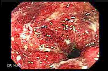 enfermedad_crohn_colitis_ulcerosa/colitis_ulcerosa_ulcerativa_inespecifica_severa