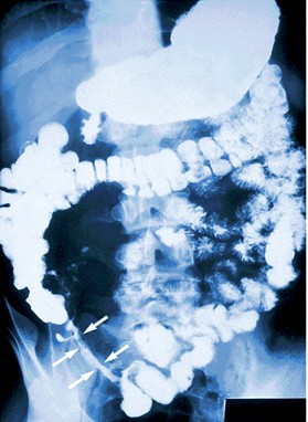 enfermedad_crohn_colitis_ulcerosa/crohn_radiografia_abdominal_contraste
